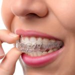 Take a deep breath: Here is all you need to know before getting braces for your teeth.