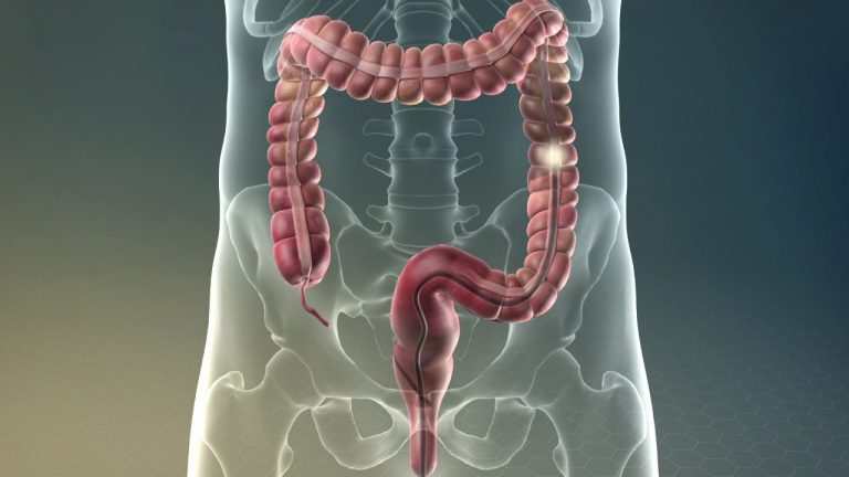 Tips for Choosing the Right Doctor for Colonoscopy in Singapore